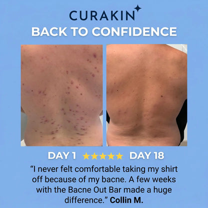 Curakin - Bacne Soap