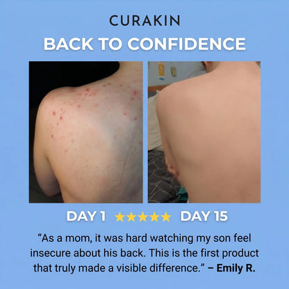 Curakin - Bacne Soap